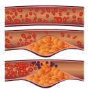 질병 "고지혈증,이상지질혈증, hyperlipidemia" 이미지