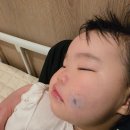 여기애가까운약국 | 아기 뺨 모기질종 수술후기｜오체안성형외과 용인기흥점에서 당일 수술했어요