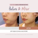 유앤린성형외과의원 | 실리프팅후기 민트실+보브실+턱끝필러 받고 1개월 효과