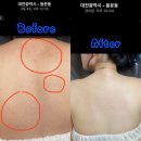 대전 등드름관리 퓨어르떼 등해초필링관리 대전화이트태닝 등
