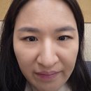 톡스앤필의원 | 불당동 톡스앤필 ) 턱 보톡스. 주름 보톡스 후기