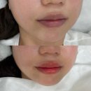 초북로 | 진주 초전동 입술디자인 반영구 후기ㅣ래아