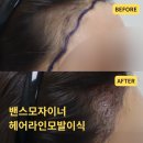 뉴사랑심는치과의원 | 밴스모자이너의원 여자헤어라인모발이식 2차 후기ㅣ수술과정 및 통증, 주의사항