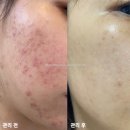 위드미 의정부흥선로점 | 의정부 피부과 없이 성인여드름 극복! 내돈내산 솔직 후기 [ 비움 에스테틱 ]