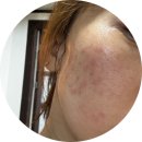 성북-길음-303 | 성북피부관리 가인에스테틱에서 모공관리