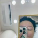 모야그집 | 편평사마귀 어븀야그 레이저 얼굴 목후기 내돈내산 편사성지