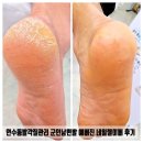 네일아이뻐 | 연수동발각질관리 군인남편발 예뻐진 네일젤이뻐 후기