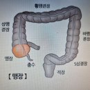 박명윤 칼럼(23-39)＞ 급성 충수염(맹장염) 이미지