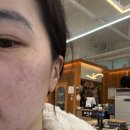 안성바른약국 | 평편사마귀제거후기 내돈내산 (2주차)병원공개!!