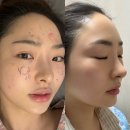 한국줄기세포 | 신사역 성형외과 MCT 프리미엄 안티에이징 골수 줄기세포 주사 BMAC 중간엽줄기세포피부주사 내돈내산 후기