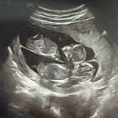 체덧,양치덧까지...난임병원 졸업후 대학병원 전원,12주 1차 기형아 검사,산모수첩 득템, 세이베베 등록