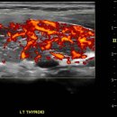 inhomogeneous parenchyma with hypervascularity in thyroid gland 이미지