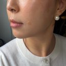 환희어린이집 - 남동구 | [판교 피부과] 40대 최대고민, 팔자주름에 맞아본 힐로 웨이브 콜라겐주사 내돈내산 후기