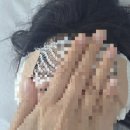 돈이돈이 | 대전 성인 이루공 수술후기 3
