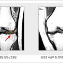 무릎 반월상 연골판 부상 증상 및 치료법 이미지