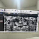 이명치과의원 | 대구 안아프게 뽑는 매복 사랑니 당일 발치 전문 톡톡사랑니치과의원