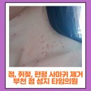 부천 점 성지 타임의원 쥐젖, 비립종, 점, 편평사마귀 제거 솔직후기 웨이팅꿀팁