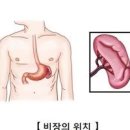 비장의 기능 위치 비대증 증상 치료 이미지