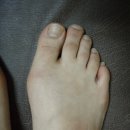 무지외반증 수술후기 하나더~!