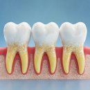 목감열린치과의원 | 평택 치과, 잇몸 치료 꾸준히 받아야 하는 사람들은?