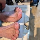 김포 구래동 내성발톱 전문 하연토탈 레푸스 안가고, 수술없이 치료하기!! [찐후기]