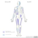 뼈에서 발생하는 희귀 악성 종양(암) 미분화 다형성 육종(Undifferentiated Pleomorphic Sarcoma, UPS) 이미지