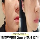 O-1 | 서면피부과 리쥬란힐러 손주사 2cc 1회차 솔직후기(엠보사진 O)