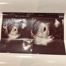 강동드림산부인과의원 | 임신 5주 차 기록: 임신 초기 증상, 임신확인서(경산모)강동드림산부인과의원