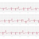 조기수축 맥박과 심전도 궁금해요 이미지