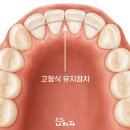 즐거운치과의원 | 의창구치과 치아교정 기간과 주의할 점