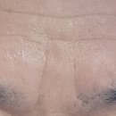 [공지] 은평구 불광역 근처 휴먼피부과 보톡스주사 솔직후기