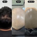 스테이 모량 | 대구 삭발커버 정수리탈모 커버 성공한 후기