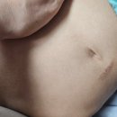 중앙제일한의원 | 지긋지긋한 아토피, 탈스 포기 및 병원진료 이야기 (국립중앙의료원)