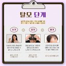 오마초등학교 | 머리 감을 때 한 움큼 빠진다면? 여성탈모 기준과 고양탈모병원 체크 포인트