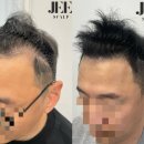 지스칼프