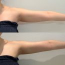 대광주유소 | 광주하이퍼소닉 통증관리 후기✨ 승모근 집중관리로 체형까지 달라진 리얼후기