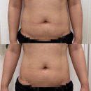 연아 | 진해복부관리 | 웨딩 관리 연아에스테틱 진해점 후기 (웨이브온+테라노바)