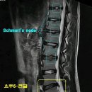 요추 5번 천추1번 수핵탈출증 (남자 21살) 미래에 대한 걱정.. 이미지