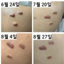 켈로이드치료 3번째 진료후기 치료비용 [강남에버성형외과]