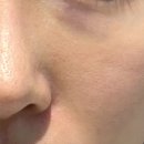 우신한의원 | 부산 스킨부스터 :: 한의원에서 모공시술 받고온 후기(내돈내산)