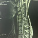 동해이레요양병원 | 경추척수증 수술 후기