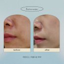 마산피부관리 에르모소 마산수분관리 전후 솔직후기