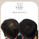 백스비어춘천스무숲점 | 30대 남성 정수리 두피문신(SMP) 후기｜비어 보이던 정수리, 자연스럽게 커버했습니다