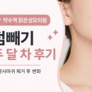 365맑은성모의원 | (내돈내산) 약수역 점빼기 성지? 맑은성모의원 두 달 차 솔직 후기｜점과 편평사마귀 제거 후기