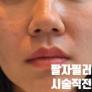 또팔자 | 신논현역 피부과 팔자필러 잘하는 곳 후기 팔자주름 한방에 해결