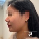 아마빌레 뷰티 | 광주 농성동 피부관리 아마빌레뷰티 이벤트 속프팅 리프팅 바로 이거다 후기사진 있음