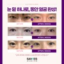 레이저로 가능한 강남 눈밑지방재배치 수술가격, 부작용, 후기