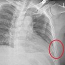 늑골 통증 갈비뼈 금갔을때 증상 골절 치료 이미지