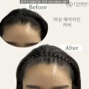 광주두피페인팅 30대 남성 내돈내산후기