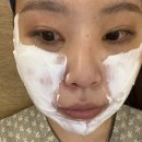 압구정피부과 울쎄라 리프팅 붓기 3주차 효과 내돈내산